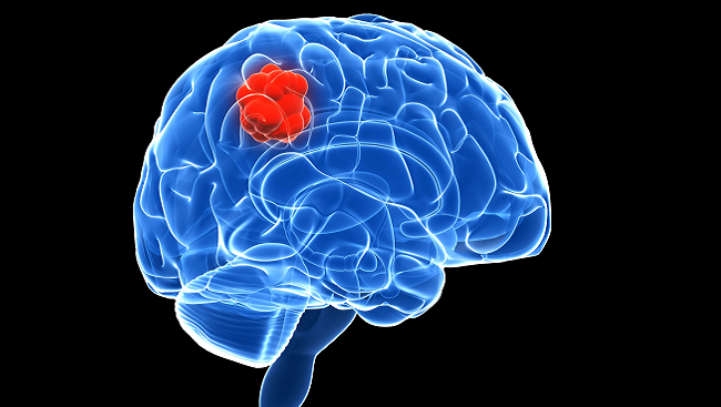 Scientists-Discover-Favorable-Drug-Merger-Against-Fatal-Childhood-Brain-Cancers